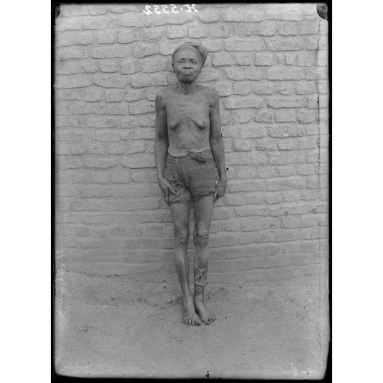 Yoko. Femme atteinte de lèpre nerveuse. [légende d'origine]