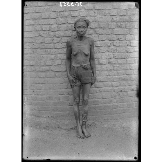 Yoko. Femme atteinte de lèpre nerveuse. [légende d'origine]