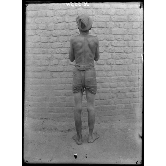 Yoko. Femme atteinte de lèpre nerveuse. [légende d'origine]