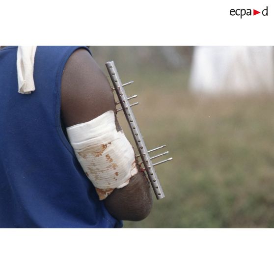 Gros plan du bras d'un enfant réfugié blessé avec une broche externe soigné à la 14e antenne chirurgicale parachutiste (14e ACP) à Goma.