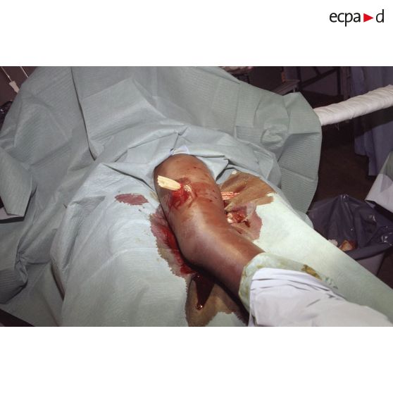 Opération chirurgicale sur la jambe transpercée par une balle d'une personne rwandaise au campement de l'élément militaire médical d'intervention rapide (EMMIR) à Cyangugu. Une mèche a été introduite dans le trou.