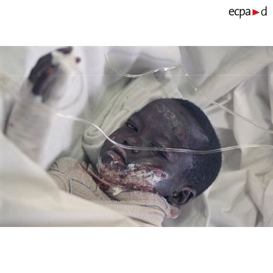 Portrait d'un enfant au visage contusionné soigné à l'élément militaire médical d'intervention rapide (EMMIR) au campement de Cyangugu.
