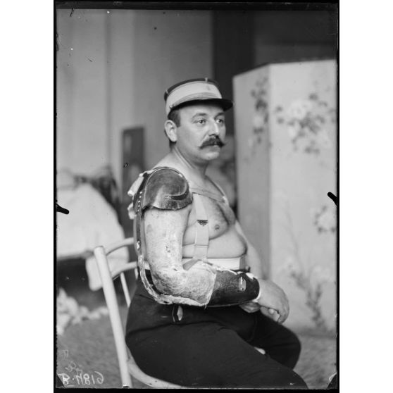 Paris, hôpital du Grand Palais. Soldat à qui l'on a greffé au bras un os de la jambe d'un camarade, appareil des docteurs Laurent et David. [légende d'origine]