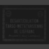 Désarticulation tarso-métatarsienne de Lisfranc, procèdé à deux lambeaux.