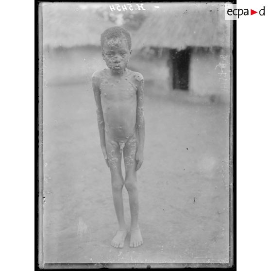 Route de Yaoundé à Yoko. Nghila. Enfant atteint du pian. [légende d'origine]