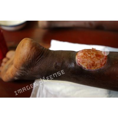 Plaie à la jambe soignée au centre de santé urbain de Bédé Combattant.